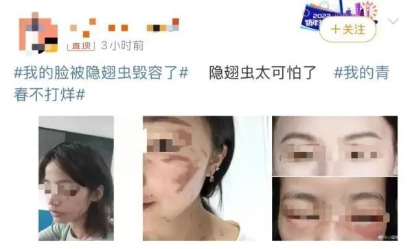 隐翅虫的毒液堪比硫酸！专家提醒：见到千万别拍(图2)